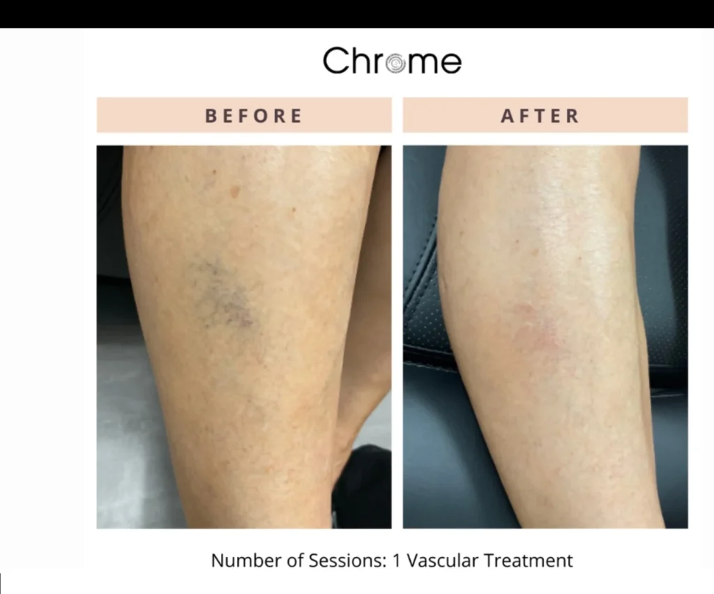 Spider Veins in Union, KY | Premium Medspa In Union, KY | Elite Medspa