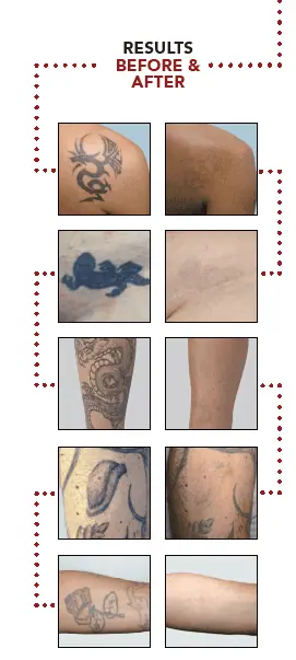 Laser Tattoo Removal in Union, KY