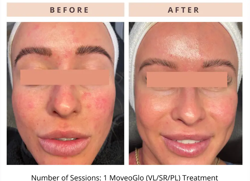 Rosacea Treatment in Union, KY