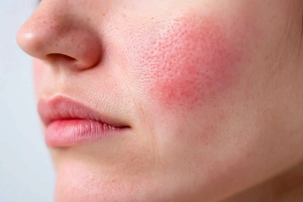 Rosacea by Elite Medspa in Union, KY