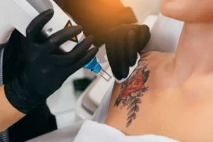 Laser Tattoo Removal in Union, KY by Elite Medspa