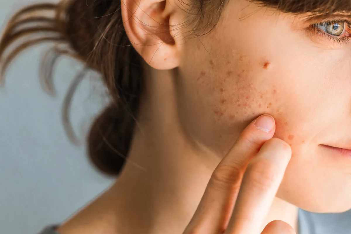 Top Acne Treatments for Clearer, Healthier Skin